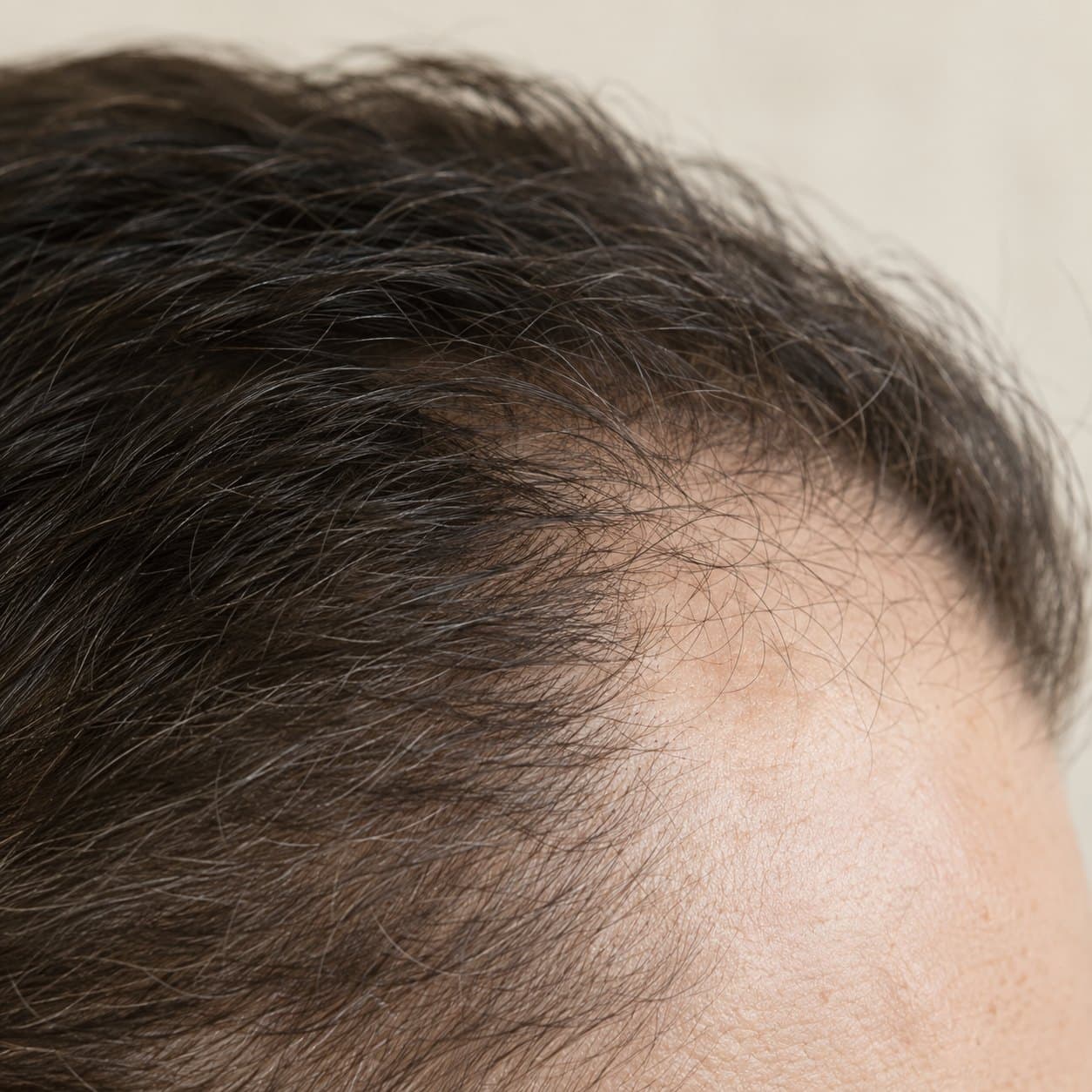 Close crop of a thinning hairline, no face